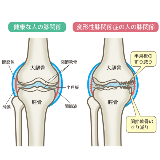 膝関節痛でお悩みのあなたへ - 高知市高知駅の頭痛専門整体・理学療法士 高知オステオパシー施術院